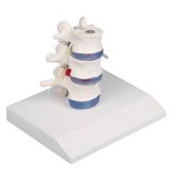 VERTEBRES LOMBAIRES DEMONTABLES AVEC HERNIE