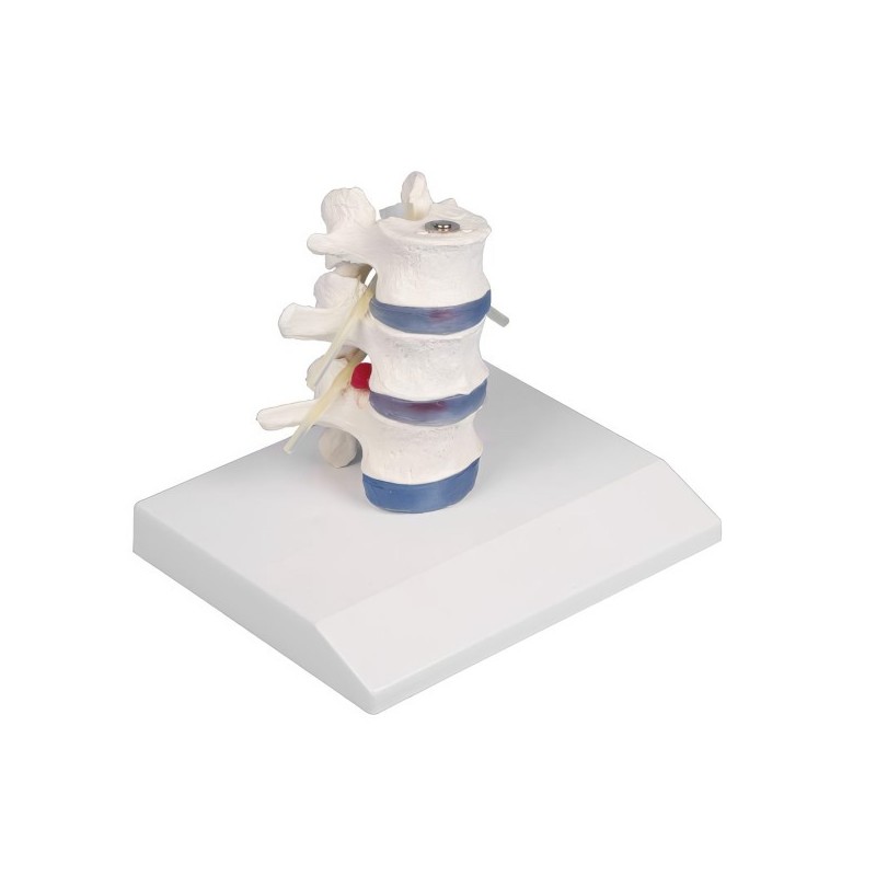VERTEBRES LOMBAIRES DEMONTABLES AVEC HERNIE